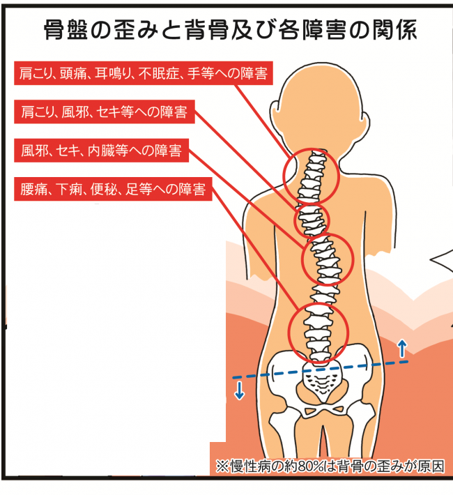 骨盤の歪みと背骨および各障害の関係イラスト