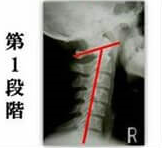 ストレートネックの頚椎レントゲン画像