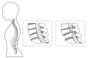 脊柱管狭窄症のイラスト図解