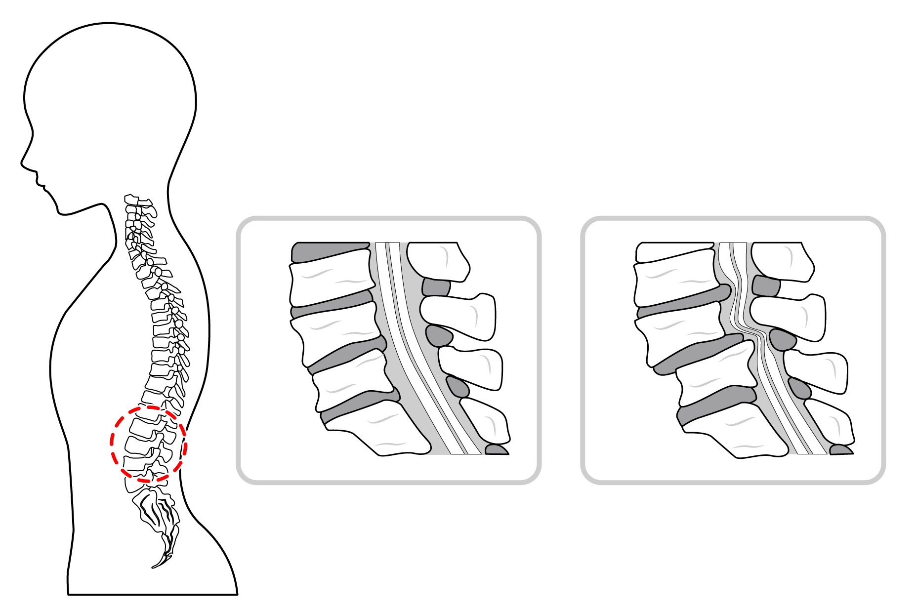 脊柱管狭窄症のイラスト図解