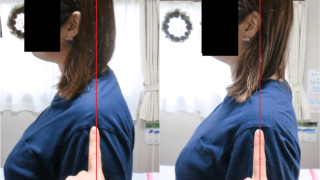 整体前後で首猫背が改善した写真