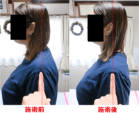 整体前後で首猫背が改善した写真