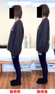 骨盤が前に出ている状態の改善前後