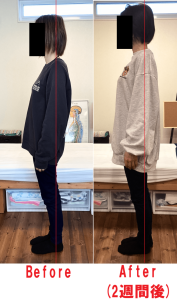 姿勢改善のBeforeAfter