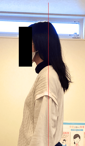 顔が前に出ている姿勢の写真。首への負担が強調されています。