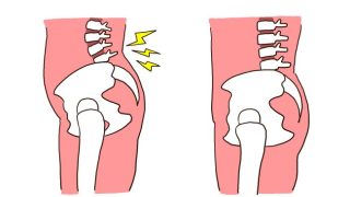 骨盤前傾のイラスト